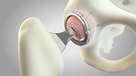 noraker_image_substituthanches_synthes3d_v1_recadre